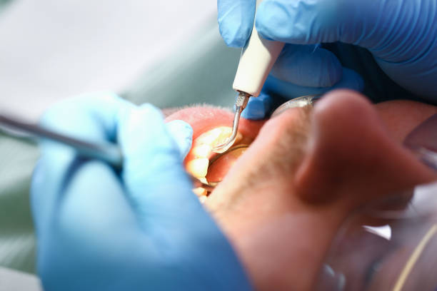Best Emergency Dental Care for Broken or Chipped Teeth in Vincent, AL