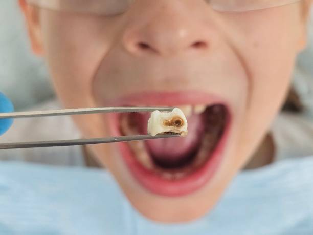 Best Emergency Treatment for Dental Infections or Abscesses in Vincent, AL
